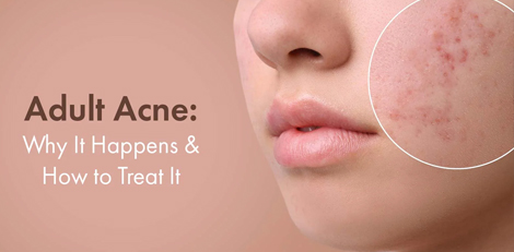 Adult Acne – Causes, treatments etc – Various important things to know!!